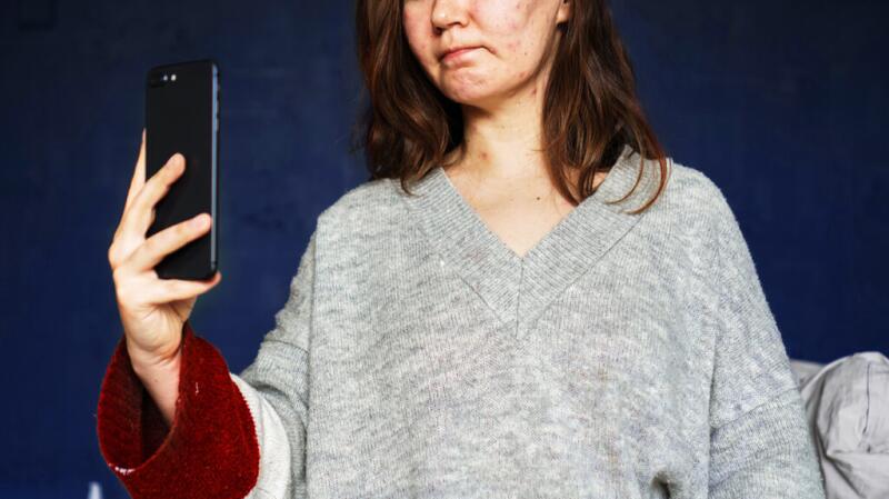 Person with acne taking a selfie