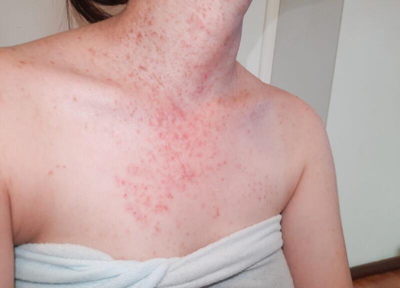 A person with a fungal acne infection on her neck and upper chest