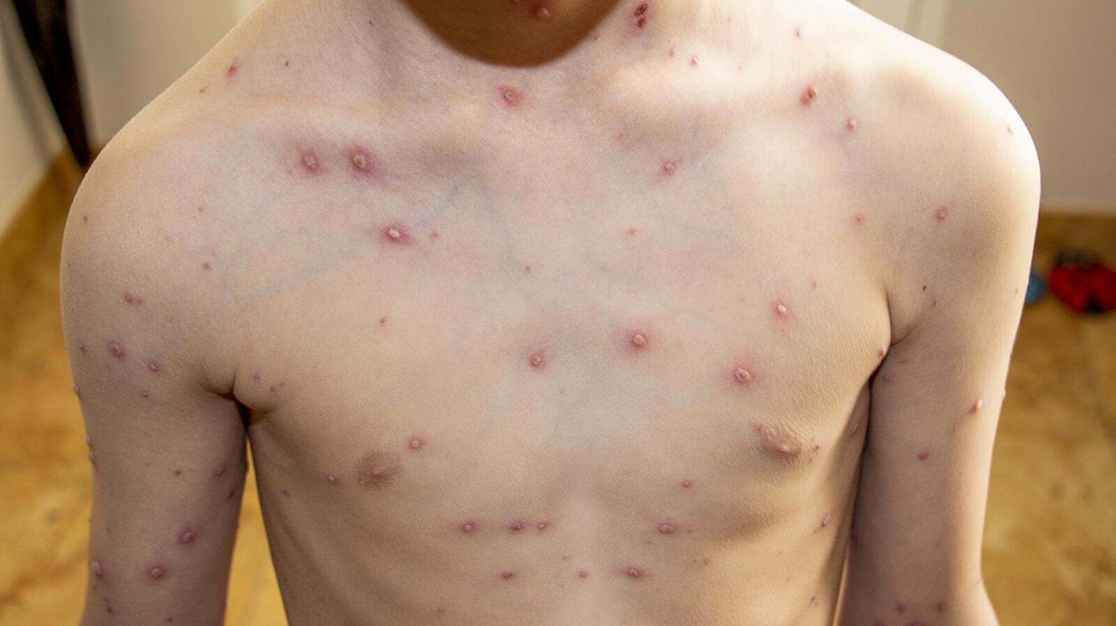 Chickenpox A Complete Guide to Symptoms, Spread, and More