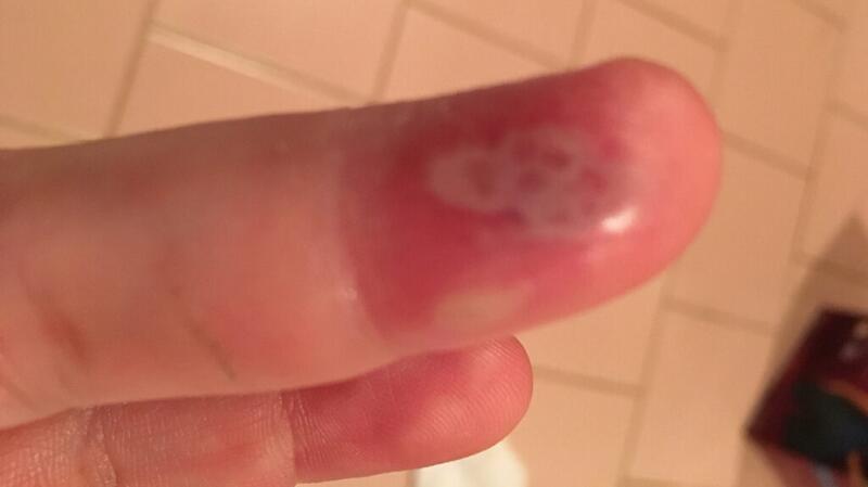 A finger infected with whitlow showing blisters and redness