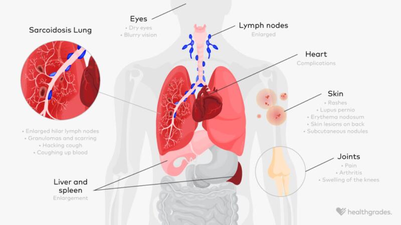 Sarcoidosis Symptoms Causes And Treatments sarcoidosis-symptoms-causes-and-treatments
