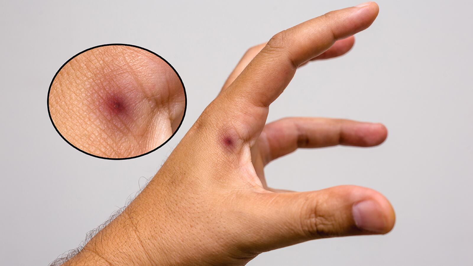 Bug Bite Pictures: Symptoms Identification Treatment and More