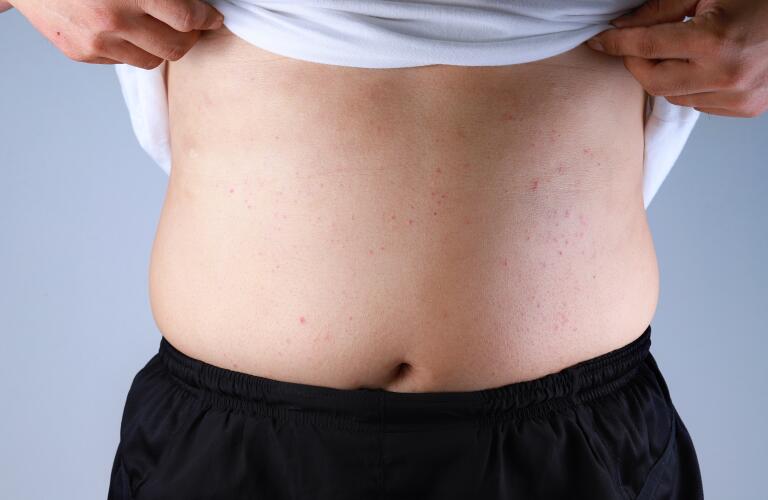 eczema (atopic dermatitis) or skin allergy on white child's stomach