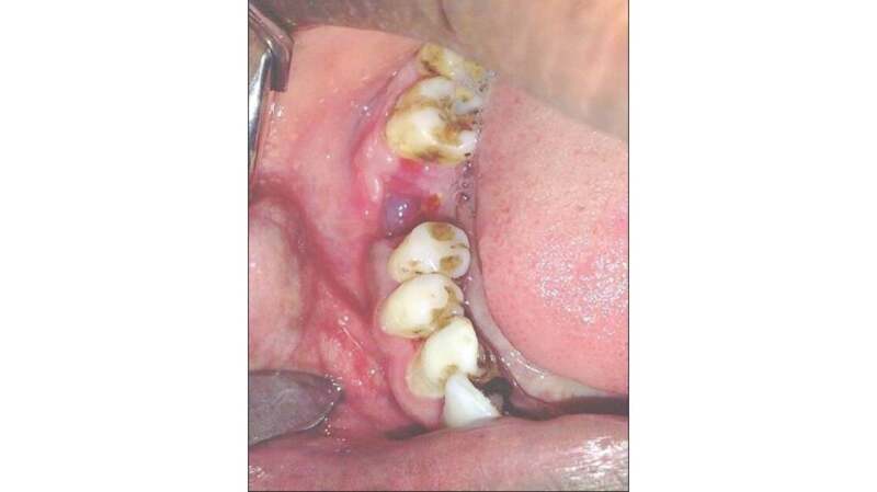 Figure 3 from Dry Socket Etiology, Diagnosis, and Clinical