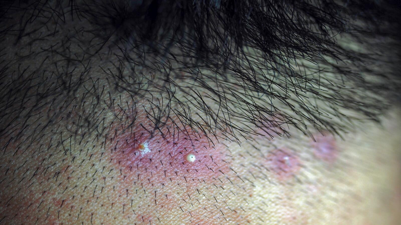 Whiteheads Causes, Pictures, and How to Get Rid of Them
