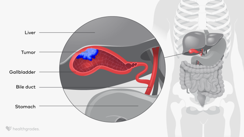 An illustration depicting a gallbladder tumor