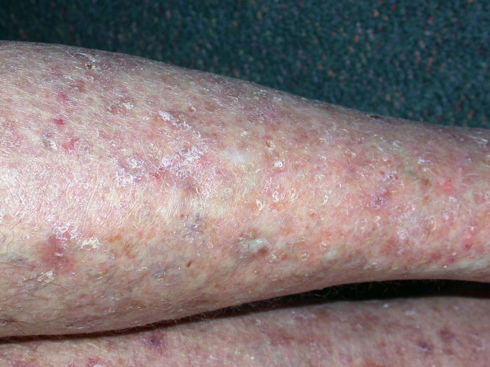 Images of Basal Cell Carcinoma: Pictures by Stage and Type