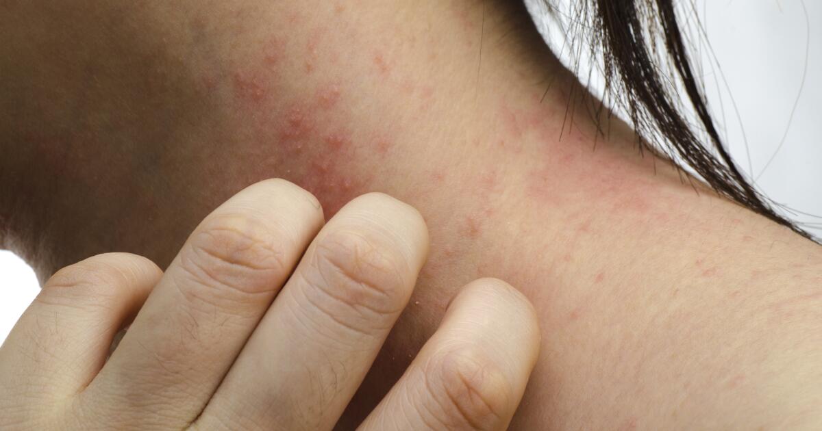 Heat Rash Pictures, Symptoms, Causes, & Treatments