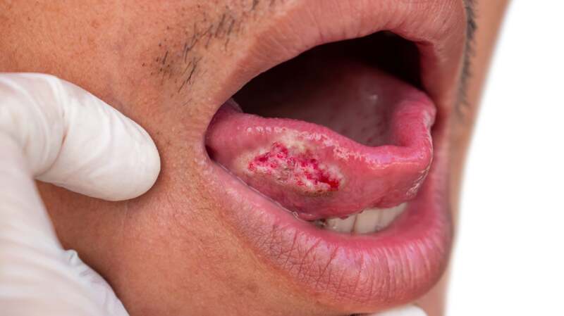 squamous cell carcinoma mouth