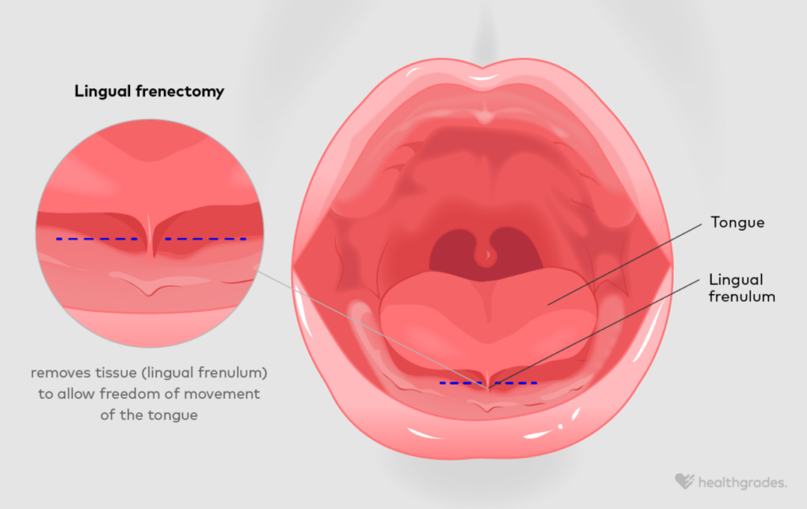 Frenectomy Definition Reasons Recovery