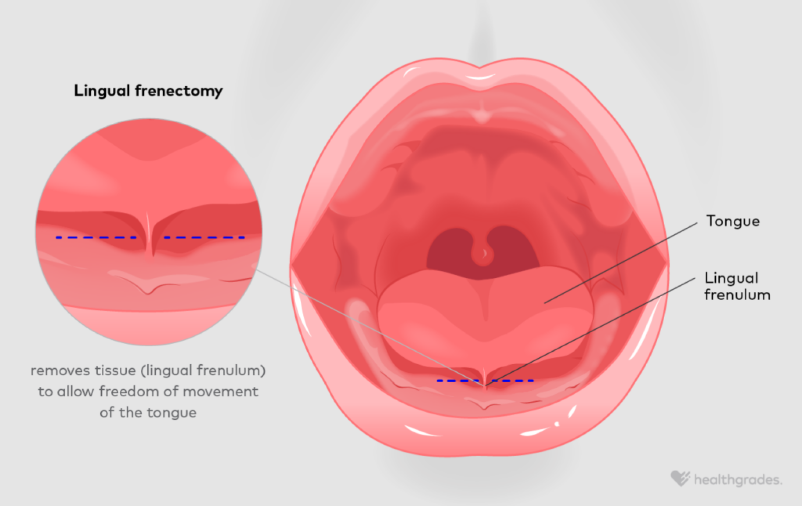 Frenectomy: Definition, Reasons, Recovery
