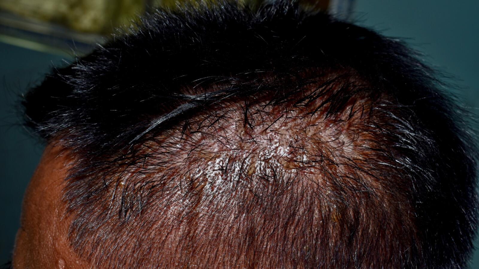 Sebaceous Rash Seborrheic Dermatitis: Symptoms, Treatments, and More