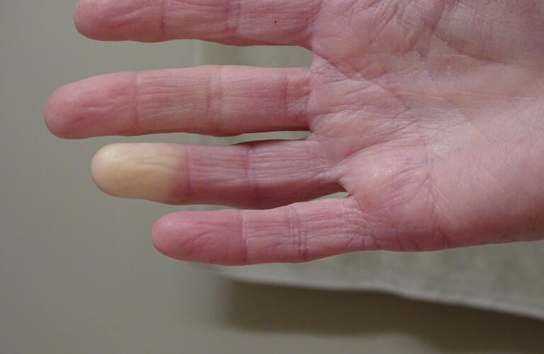 Close-up of Caucasian person's hand with Raynaud's phenomenon on ring finger