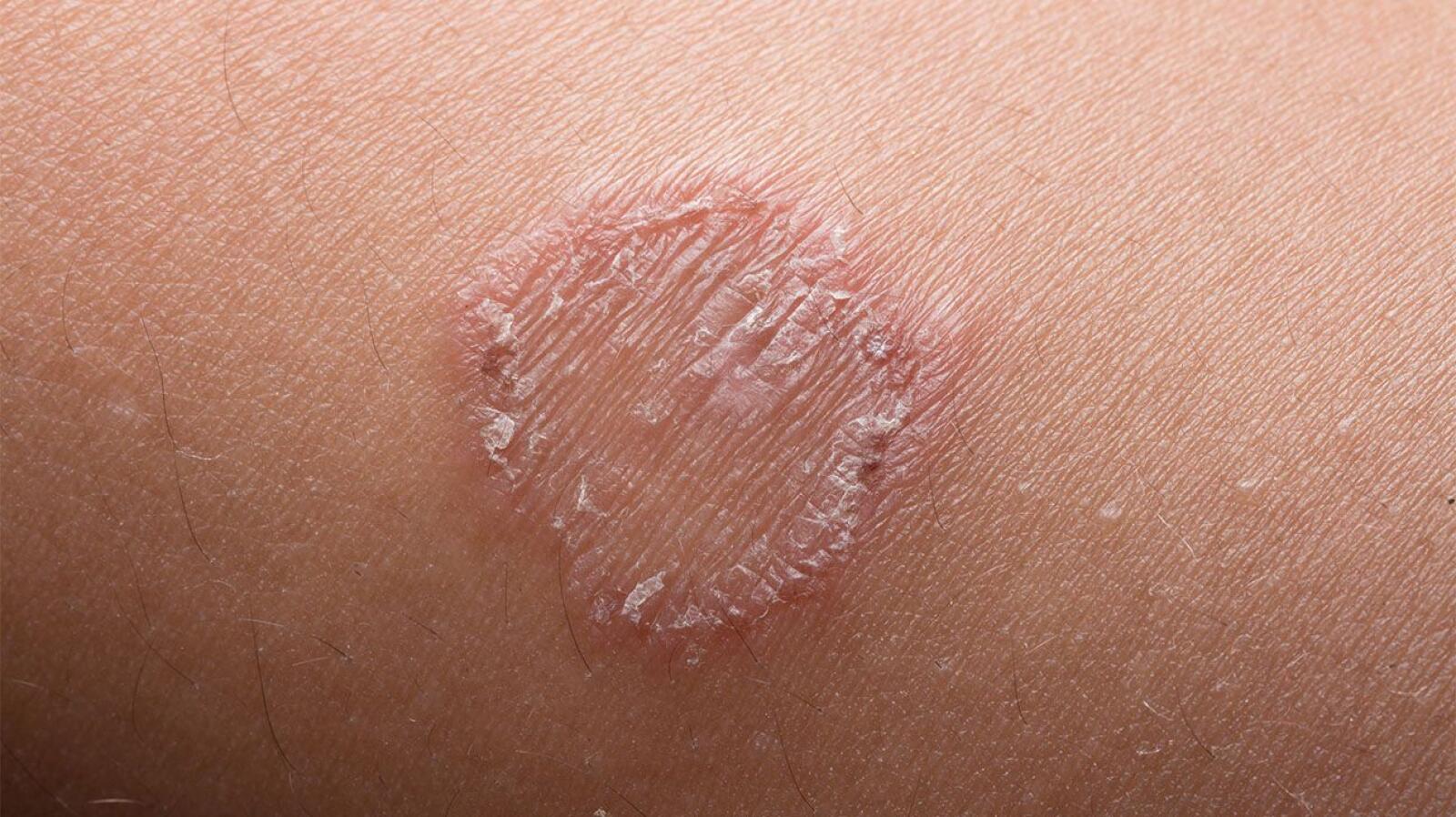 Rash on Stomach: Causes, Symptoms, and Treatment