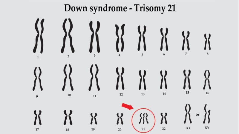 down syndrome karyotype