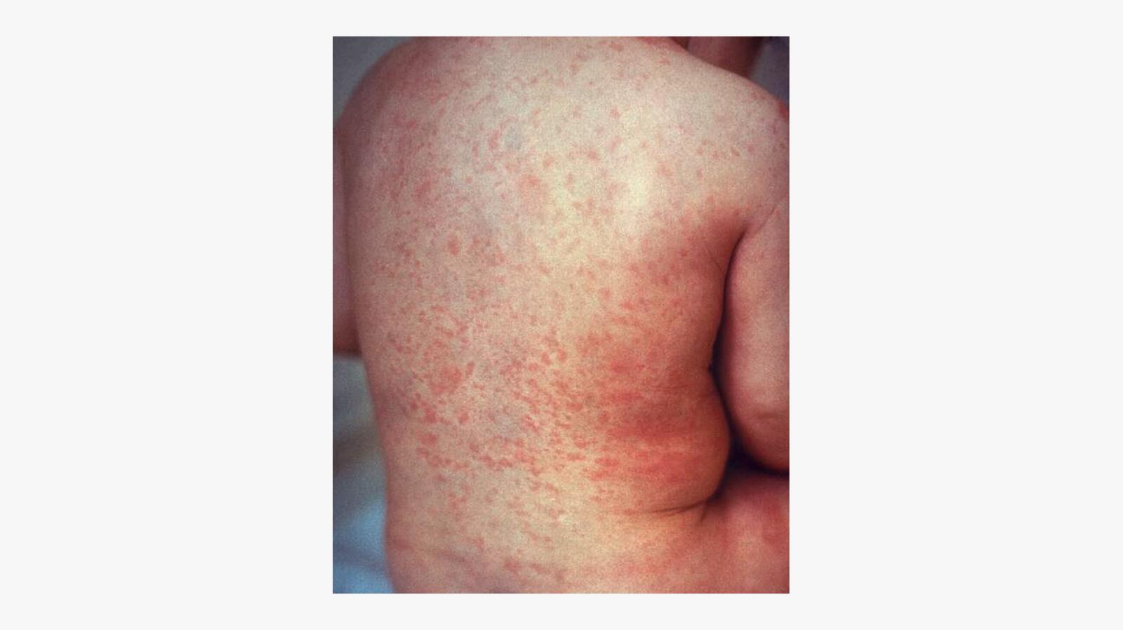 Rubella: Symptoms, Treatments, Causes, Vaccine, and More