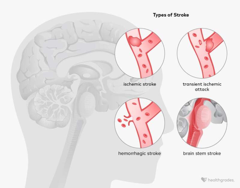 Types of Strokes, Symptoms, Treatments, Causes, and More