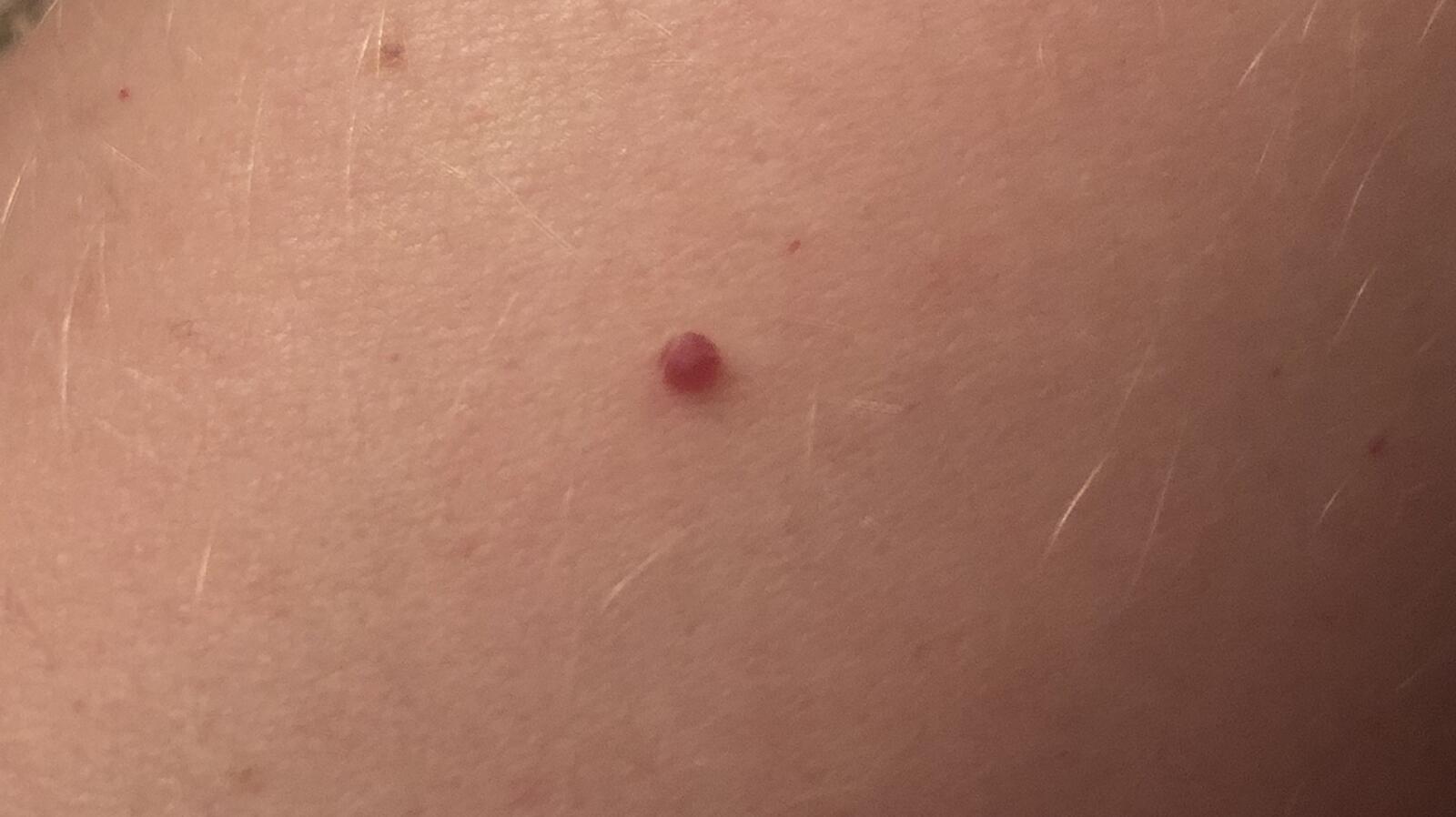 Cherry Angioma Symptoms, Causes, Treatment, and Removal