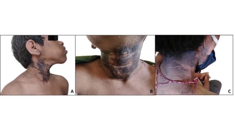 Dermatitis neglecta can appear as hyperpigmented patches which are scaly and flaky.