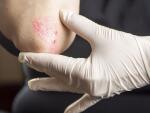 psoriasis-on-elbow