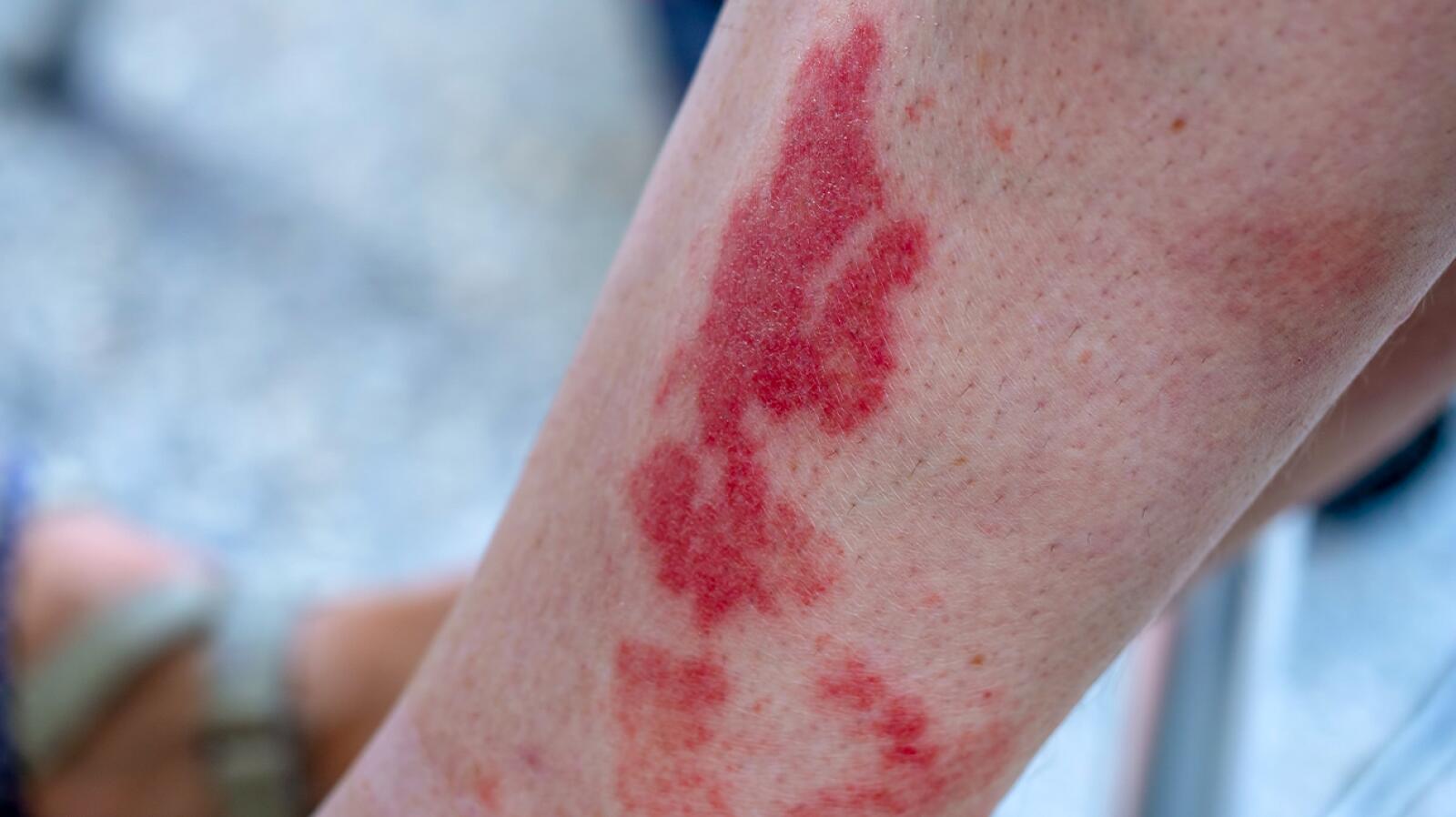 Rash On Legs Causes And Treatment