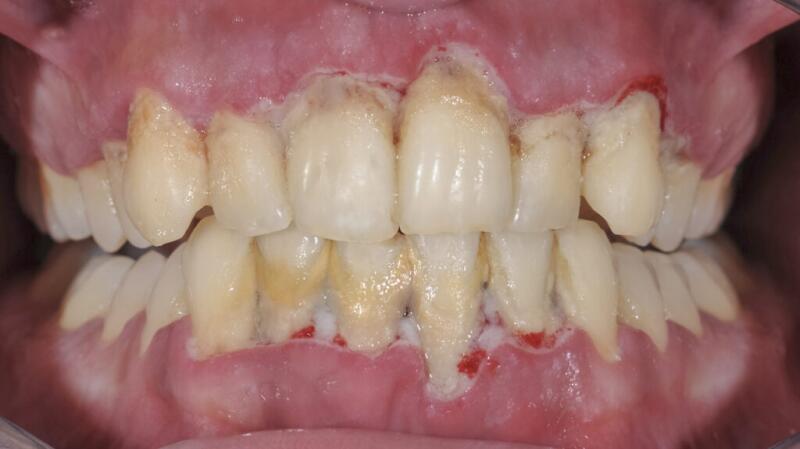 heavy calculus buildup on bottom teeth