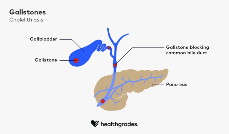 illustration of gallstones in the gallbladder and common bile duct to the pancreas