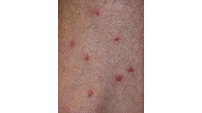 Triangle Bite Bug Bites in a Line: Identification, Treatments, and More