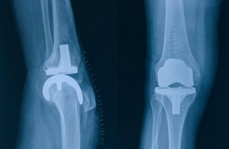knee replacement xray