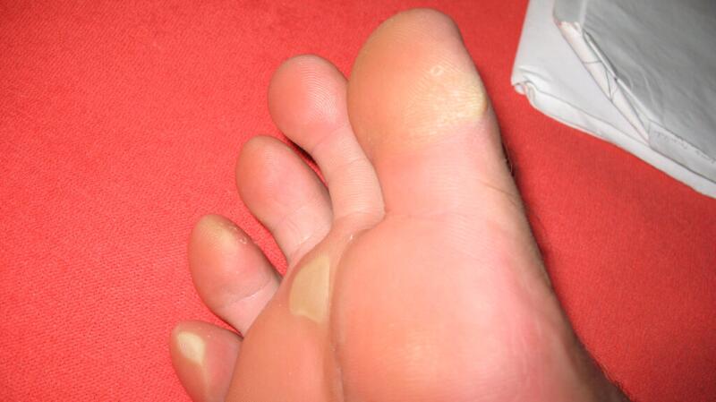 Image of calluses on toes and ball of foot
