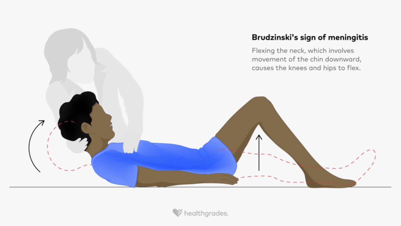 Brudzinski's Sign: Purpose, Limitations, Diagnosis, and More