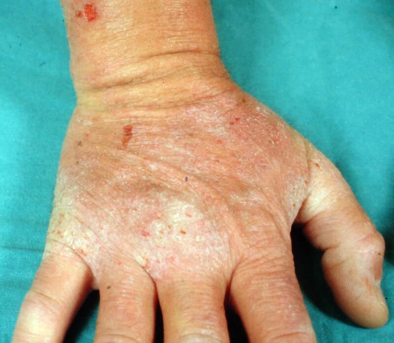 gluten rash