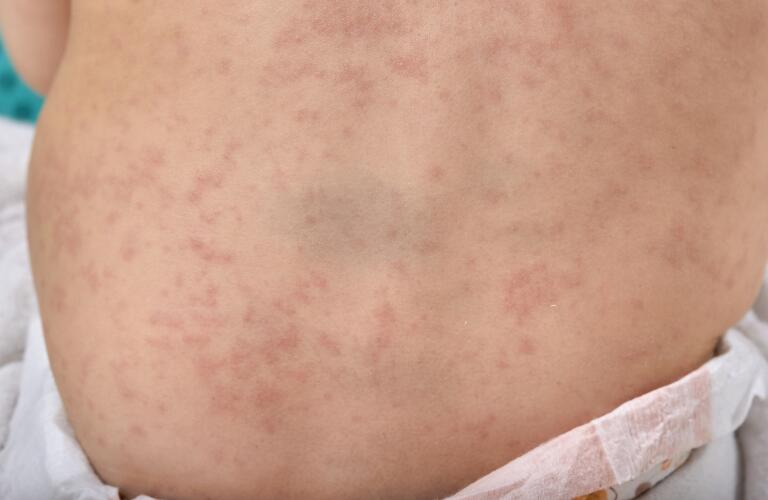 roseola, a viral rash on the skin of a white child in diapers