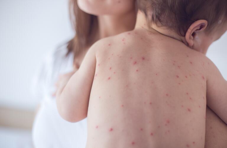 allergic reaction rash on babies