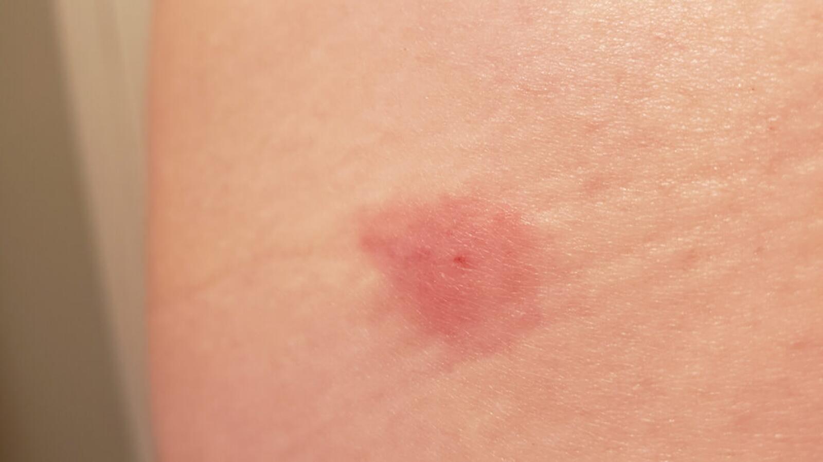 Bug Bite Pictures Symptoms Identification Treatment And More