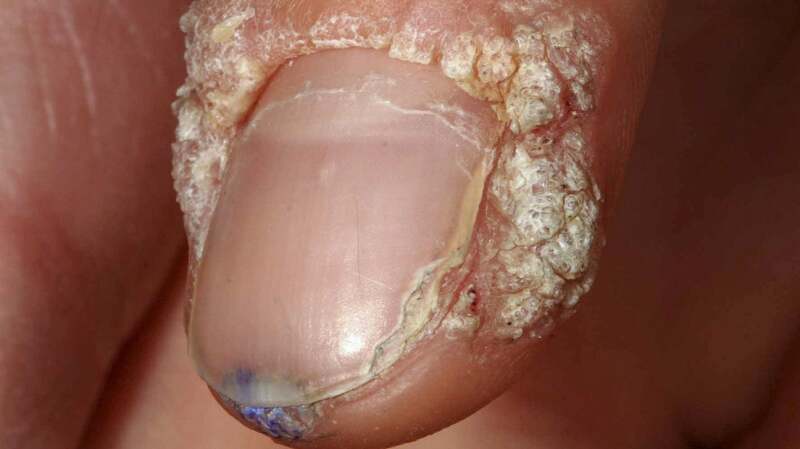 subungual warts pictures