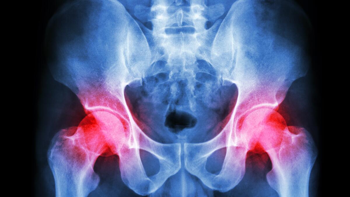 DEXA Bone Density  Arthritis & Sports