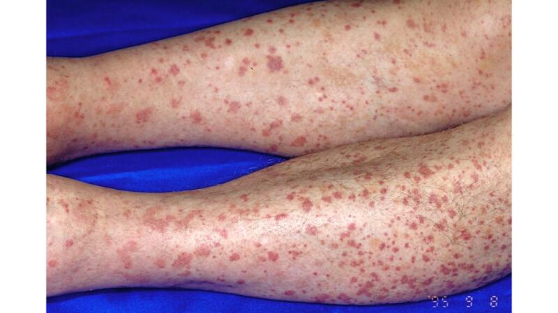 Causes of Red Bumps and Spots on Legs