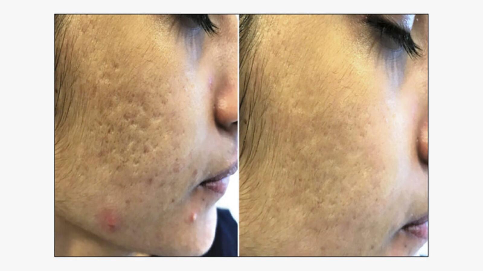 Subcision Thread Subcision: What Is It, Does It Work, and Will It Help You?