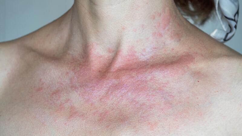 Spot This Rash–Summertime– Sun Sensitivity - Sutton Dermatology +