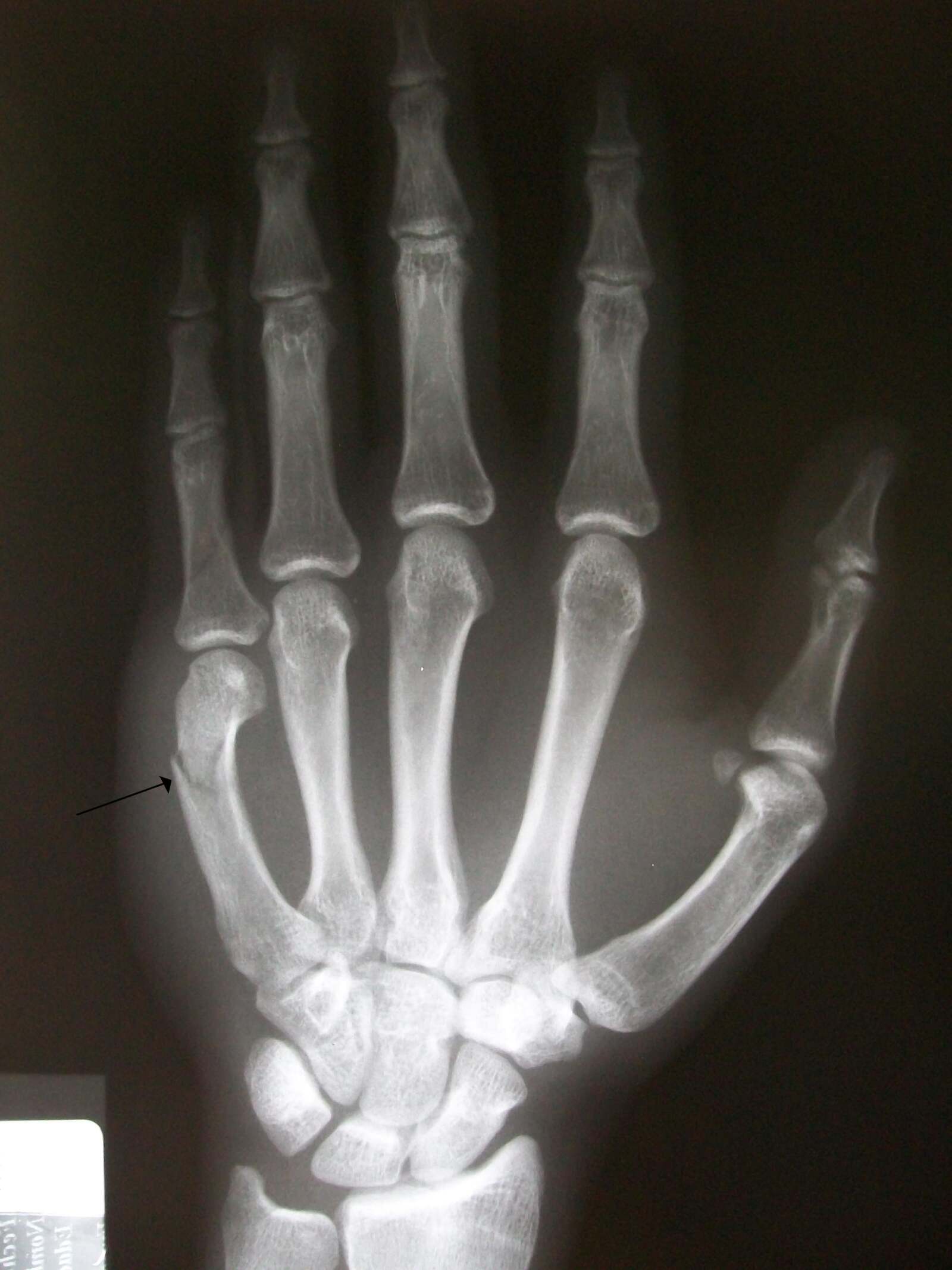 Boxer's Fracture Fifth Metacarpal Break Symptoms and Treatments