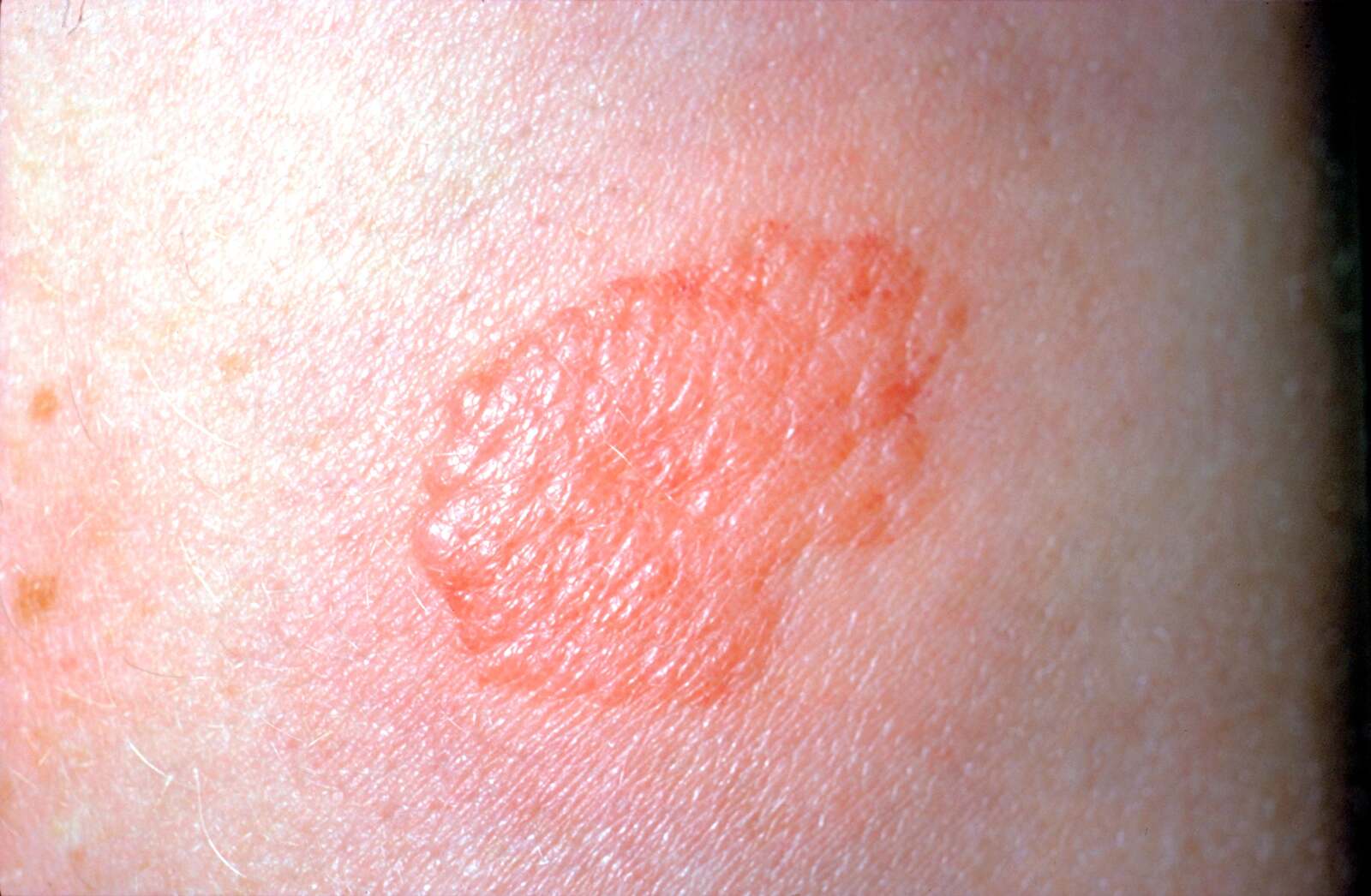 Tuberculosis Test Methods, Results, Risks, and More