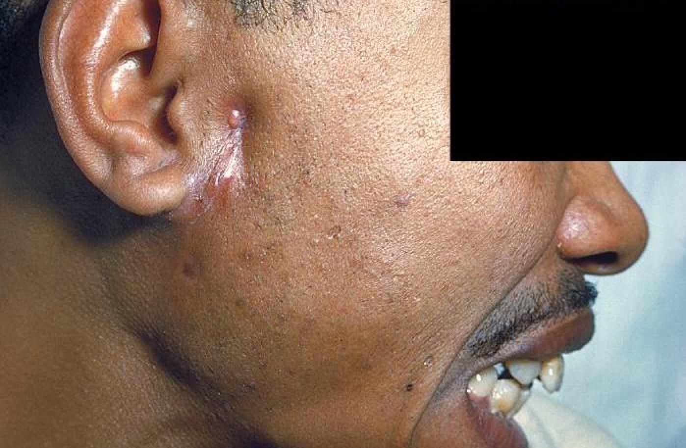 Mask Rash With Swelling Face Swelling: Causes and More