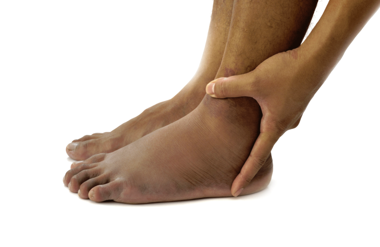 swollen feet