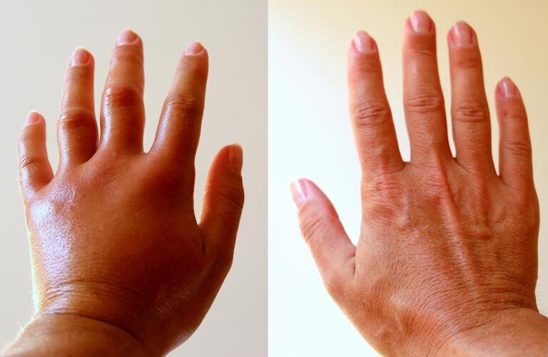 Edema and swelling in hand compared to normal hand