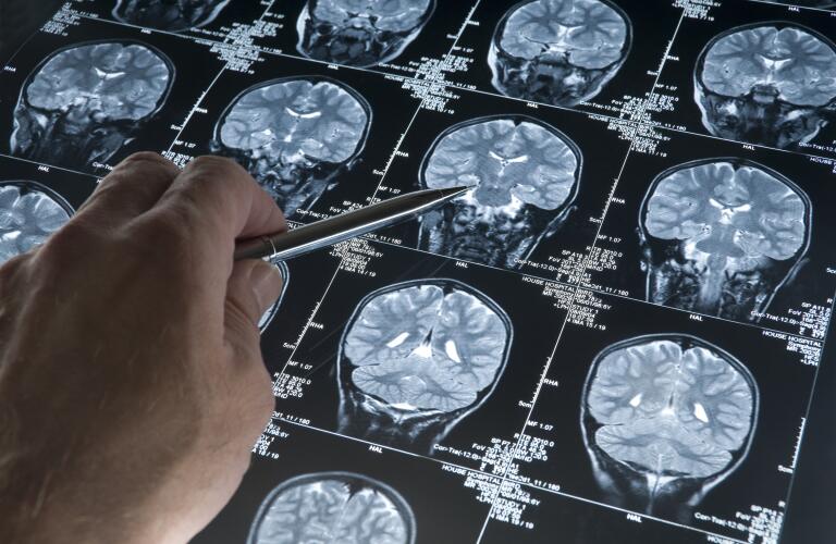 Male doctor's hand examining sheet of brain MRI scans