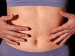Rash on Stomach: Causes, Symptoms, and Treatment