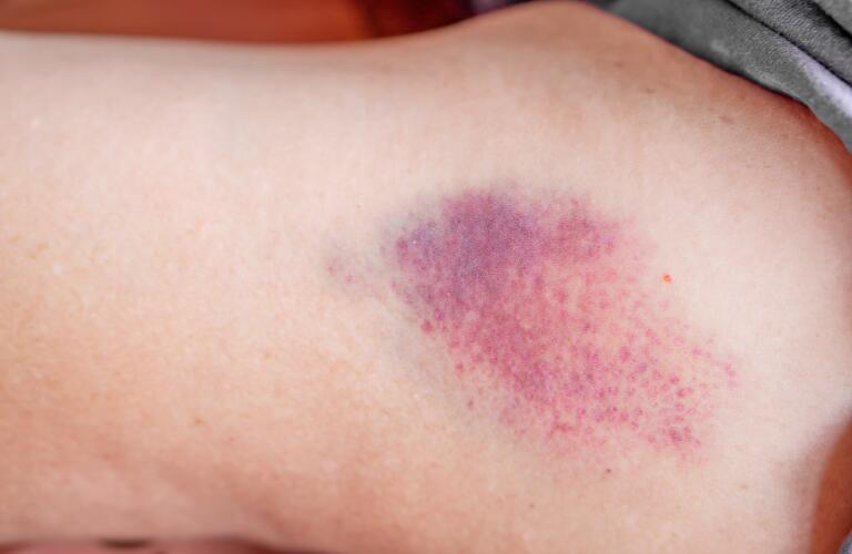 Large bruise on woman's arm  