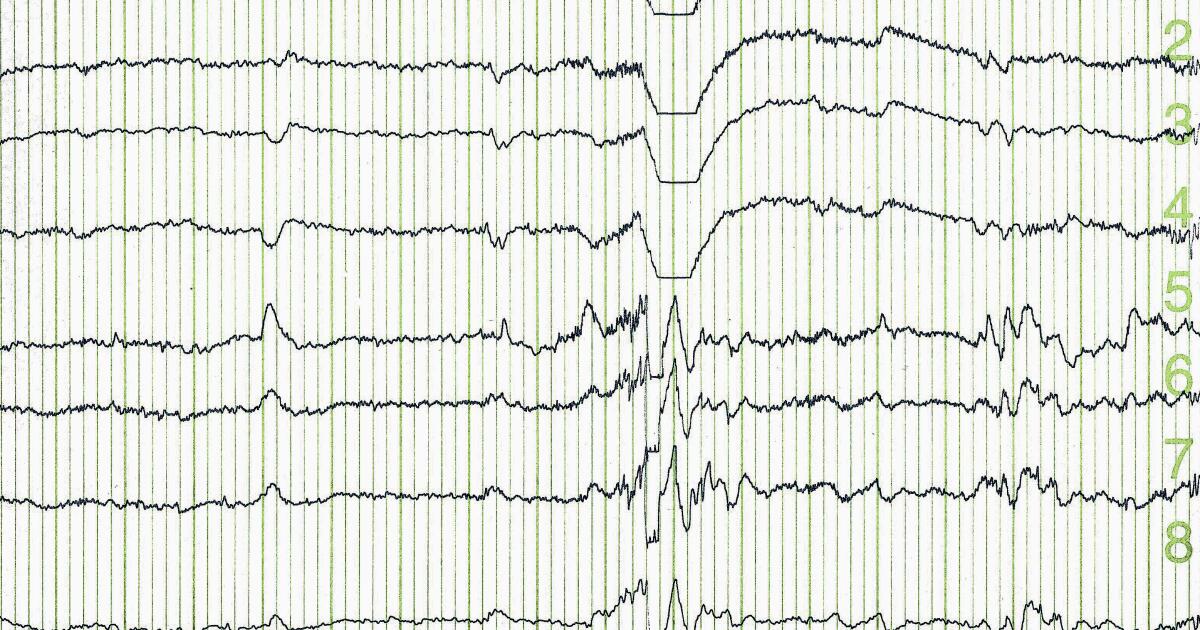 Understanding Your EEG Results | Normal & Abnormal EEGs