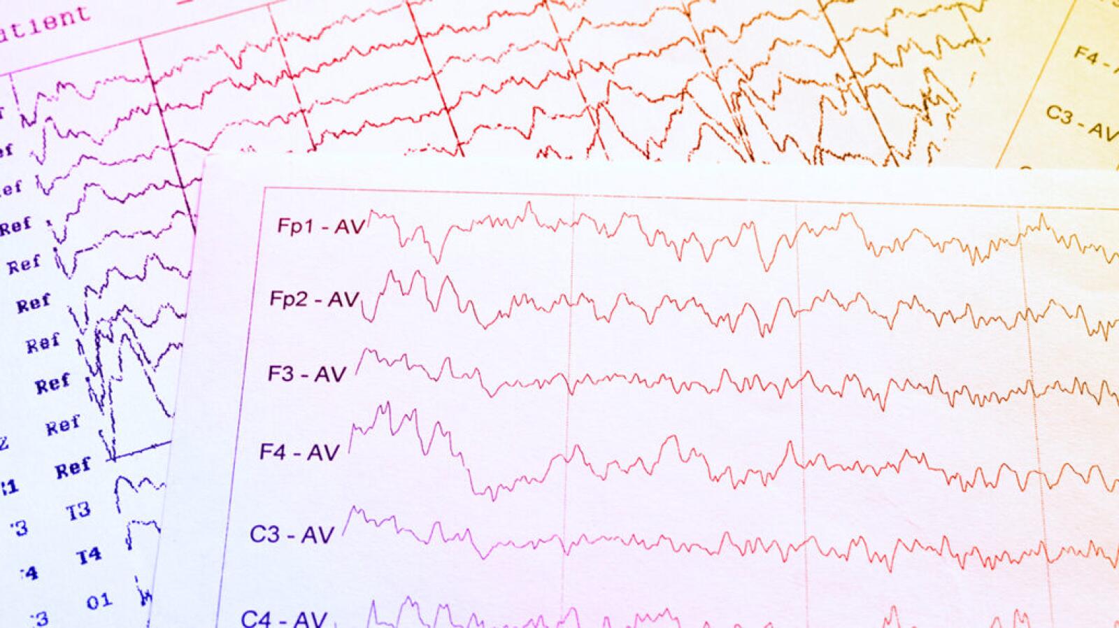 Electroencephalogram (EEG): Uses, Procedure, and Results